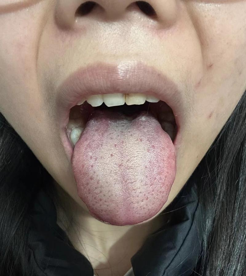 新澳今天最新资料大全和舌根和牙龈被缝一起与舌根和牙龈被缝一起怎么办